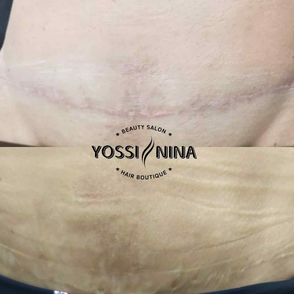 טישטוש צלקות סימני מתיחה שיחזור פיטמה (2)