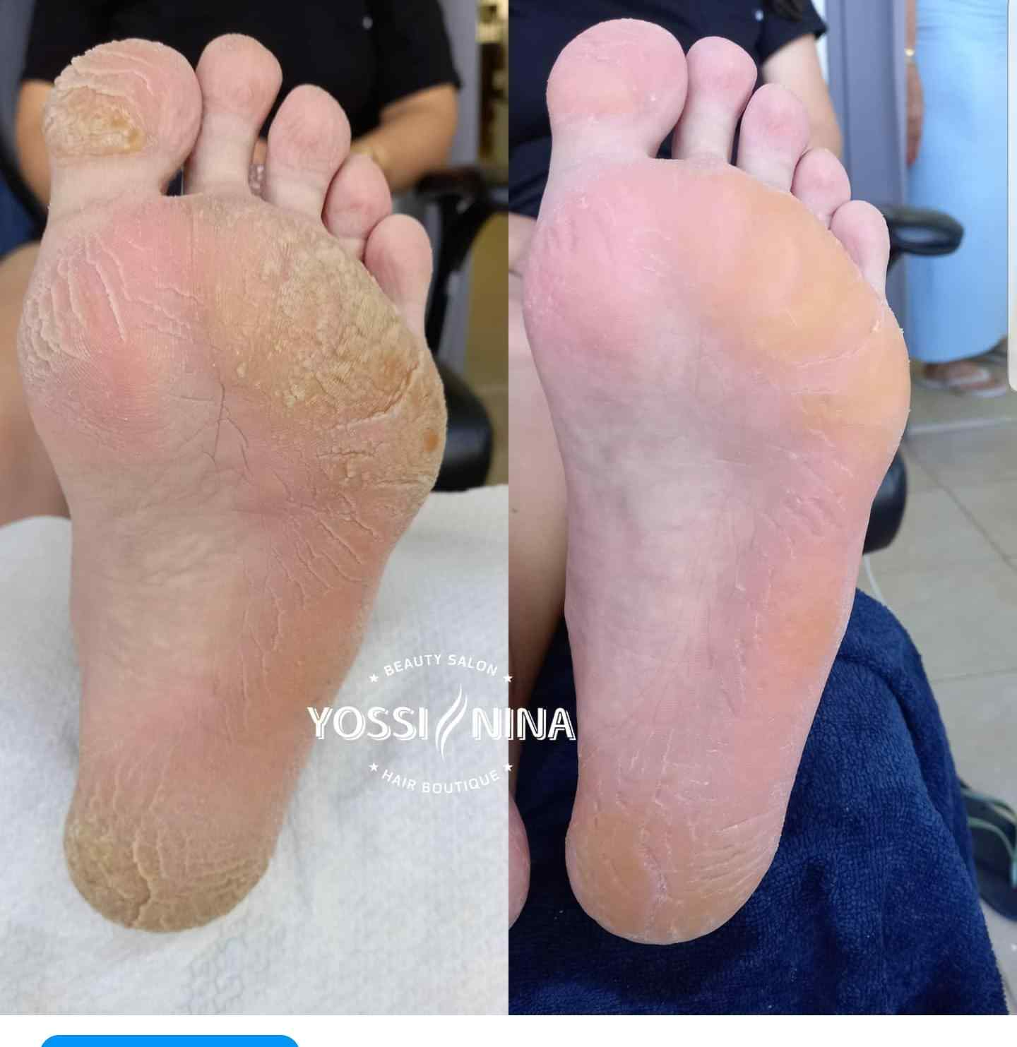 פדיקורפדיקור רפואי (3)